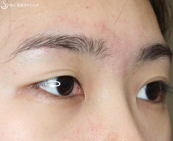 【20代女性・華やかな目】二重全切開＋脱脂（術後1ヶ月） Before 