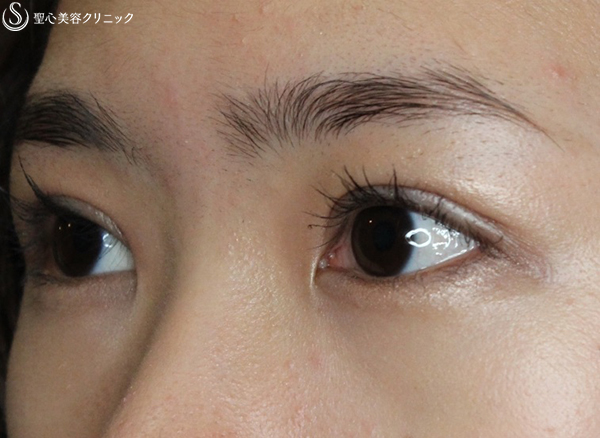 【20代女性・華やかな目】二重全切開＋脱脂（術後1ヶ月） After 