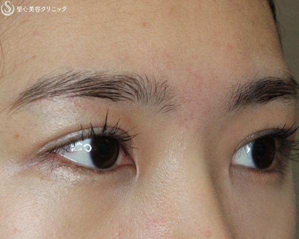 【20代女性・華やかな目】二重全切開＋脱脂（術後1ヶ月） After 