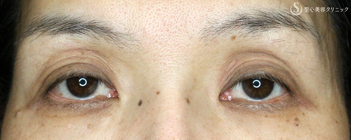 【50代女性・くぼみ目の改善効果も】「切らない眼瞼下垂+α法」単独（7年後） Before 