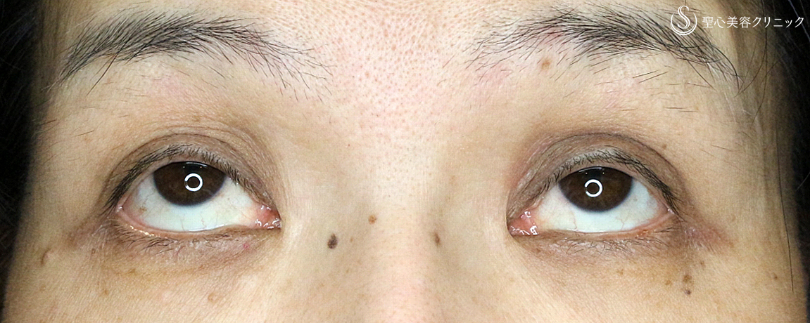 【50代女性・くぼみ目の改善効果も】「切らない眼瞼下垂+α法」単独（7年後） Before 