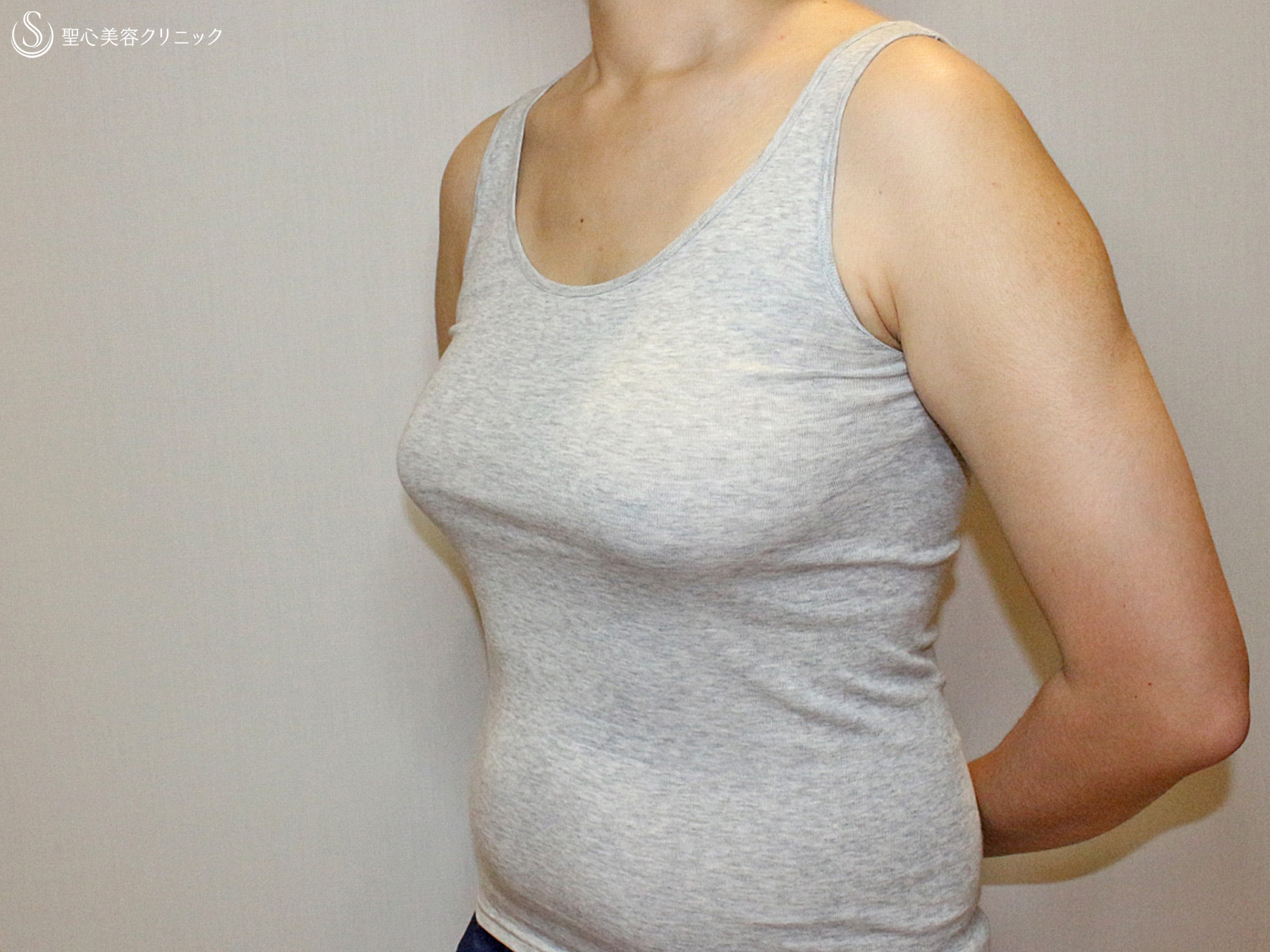【20代女性・FTM男らしい胸に】乳腺切除&脂肪吸引（6ヶ月後） Before 