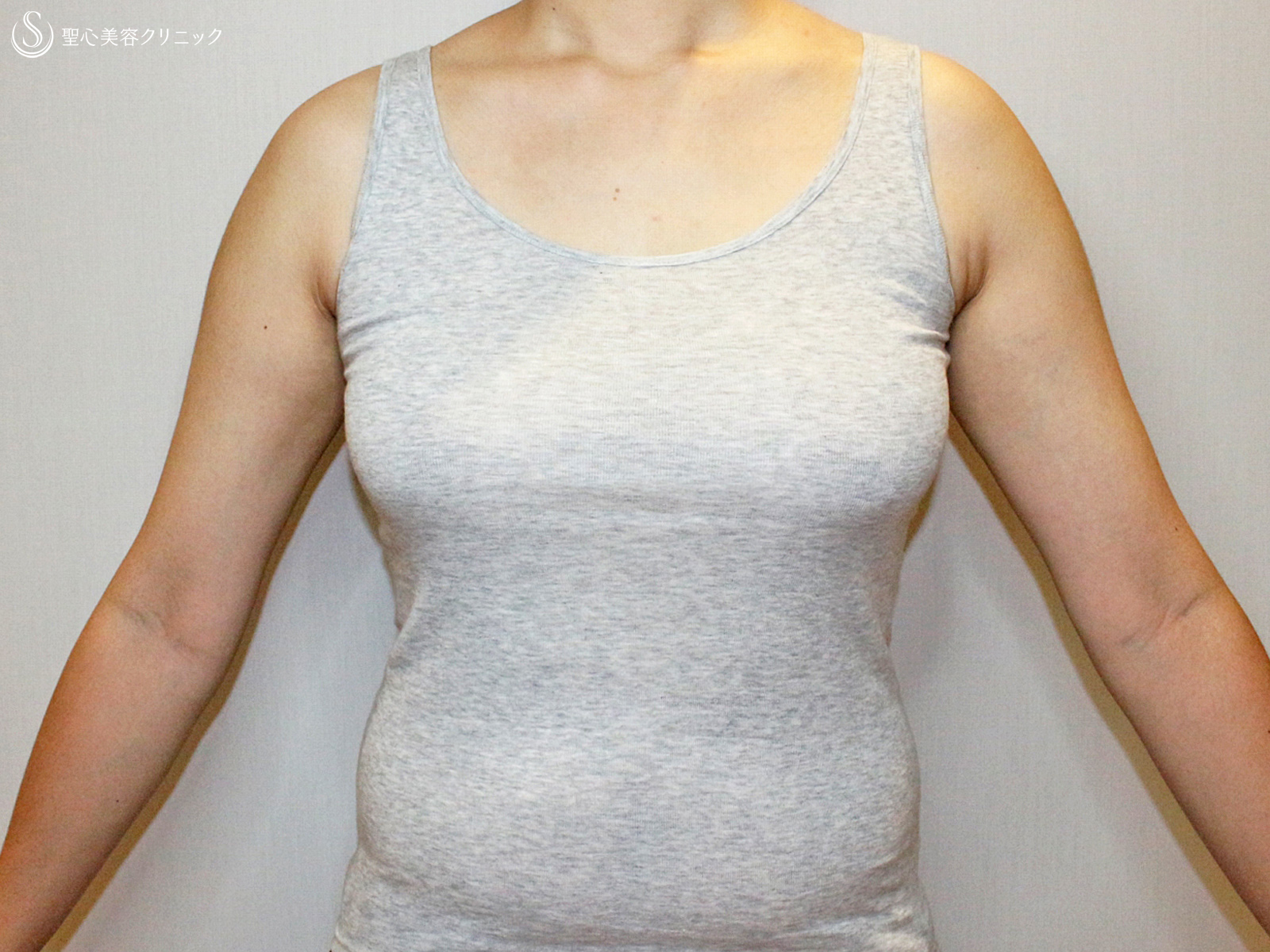 【20代女性・FTM男らしい胸に】乳腺切除&脂肪吸引（6ヶ月後） Before 