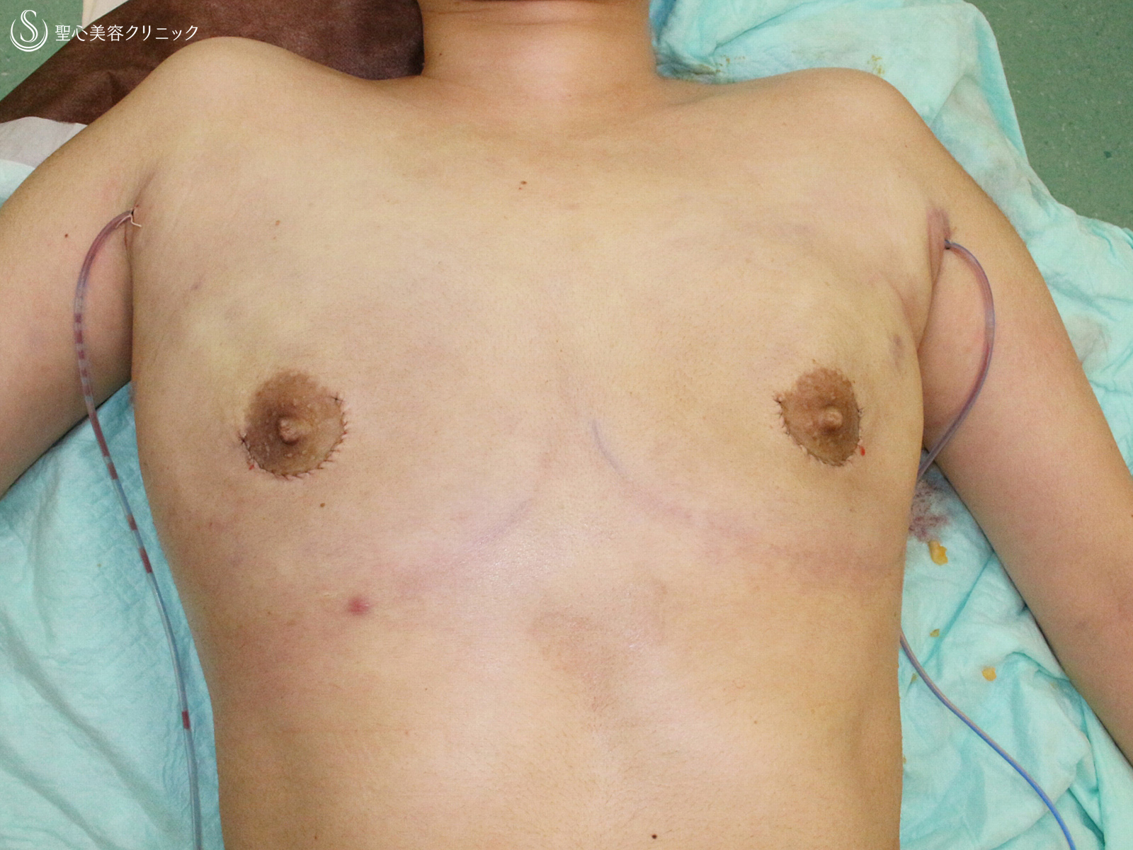 【20代女性・FTM男らしい胸に】乳腺切除&脂肪吸引（6ヶ月後） Before 