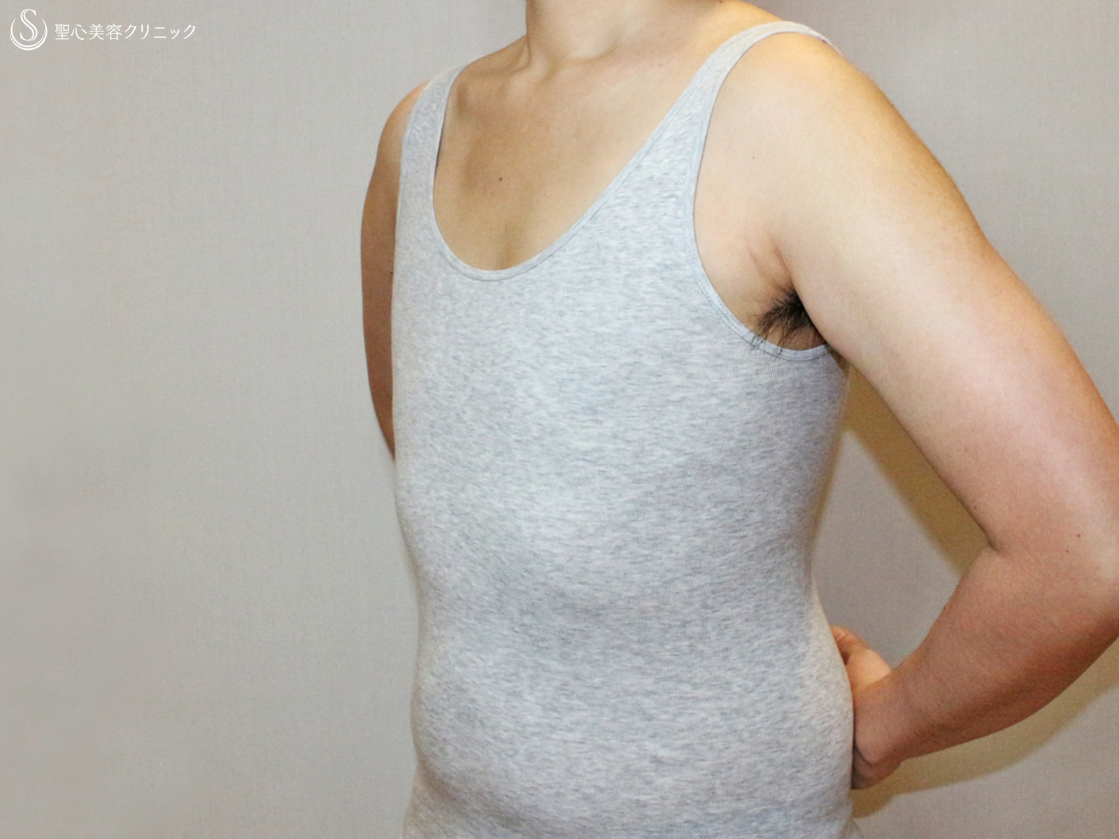 【20代女性・FTM男らしい胸に】乳腺切除&脂肪吸引（6ヶ月後） After 