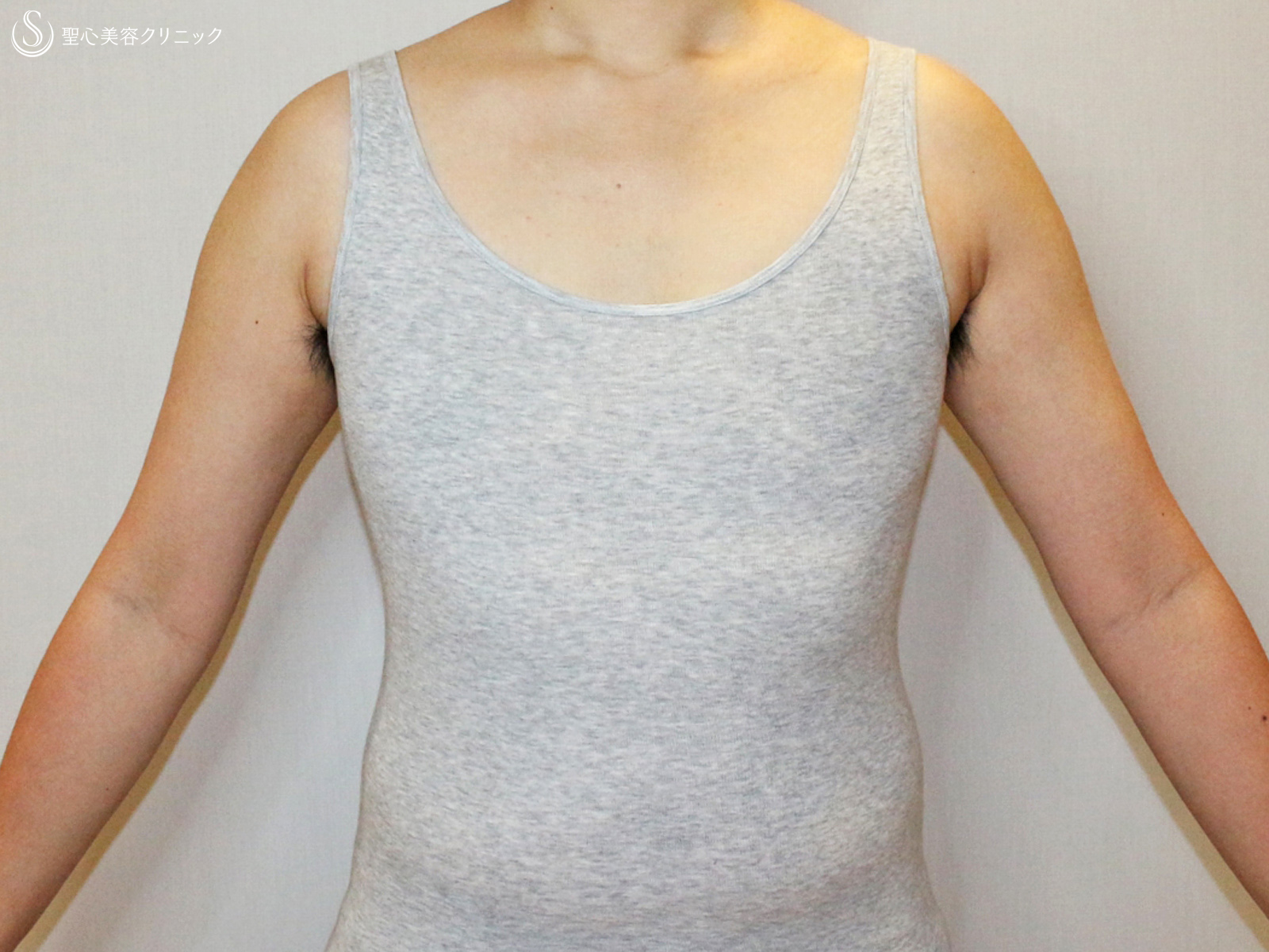 【20代女性・FTM男らしい胸に】乳腺切除&脂肪吸引（6ヶ月後） After 