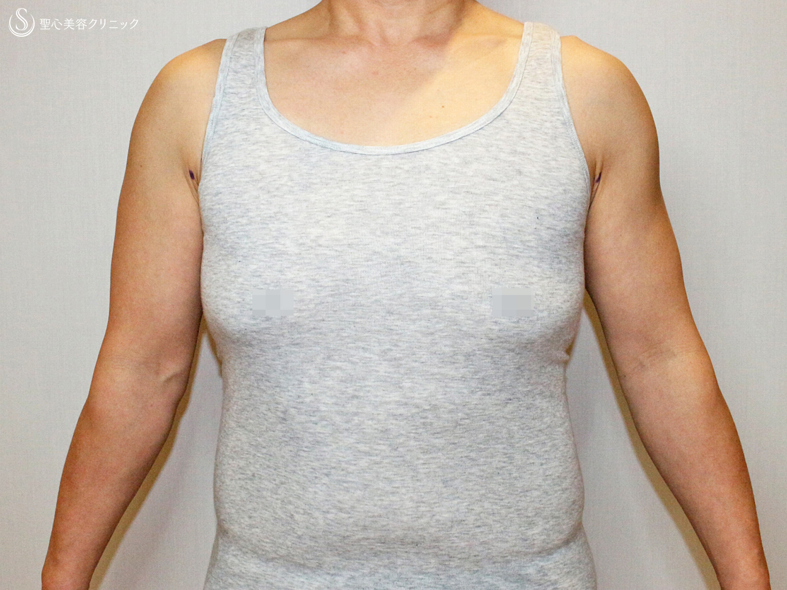 【40代女性・男らしい胸】乳腺切除＆ベイザー脂肪吸引（3ヶ月後） Before 