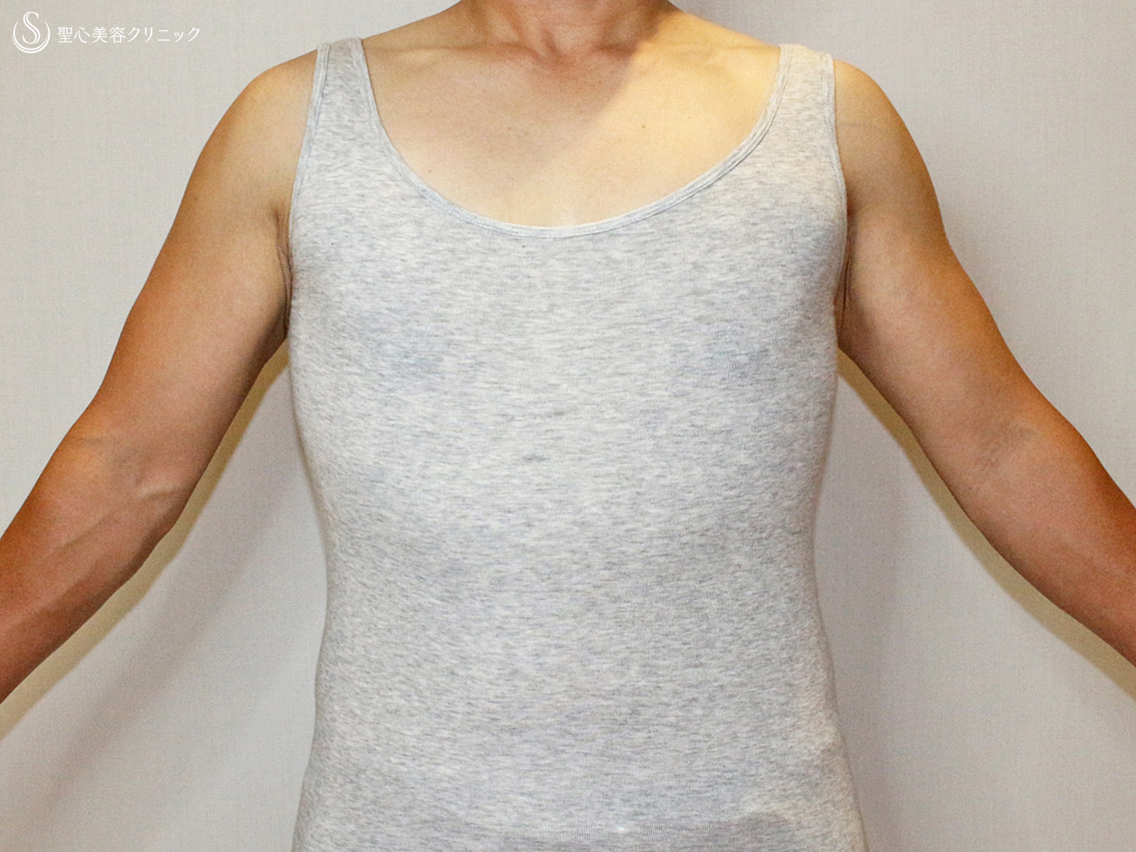 【40代女性・男らしい胸】乳腺切除＆ベイザー脂肪吸引（3ヶ月後） After 
