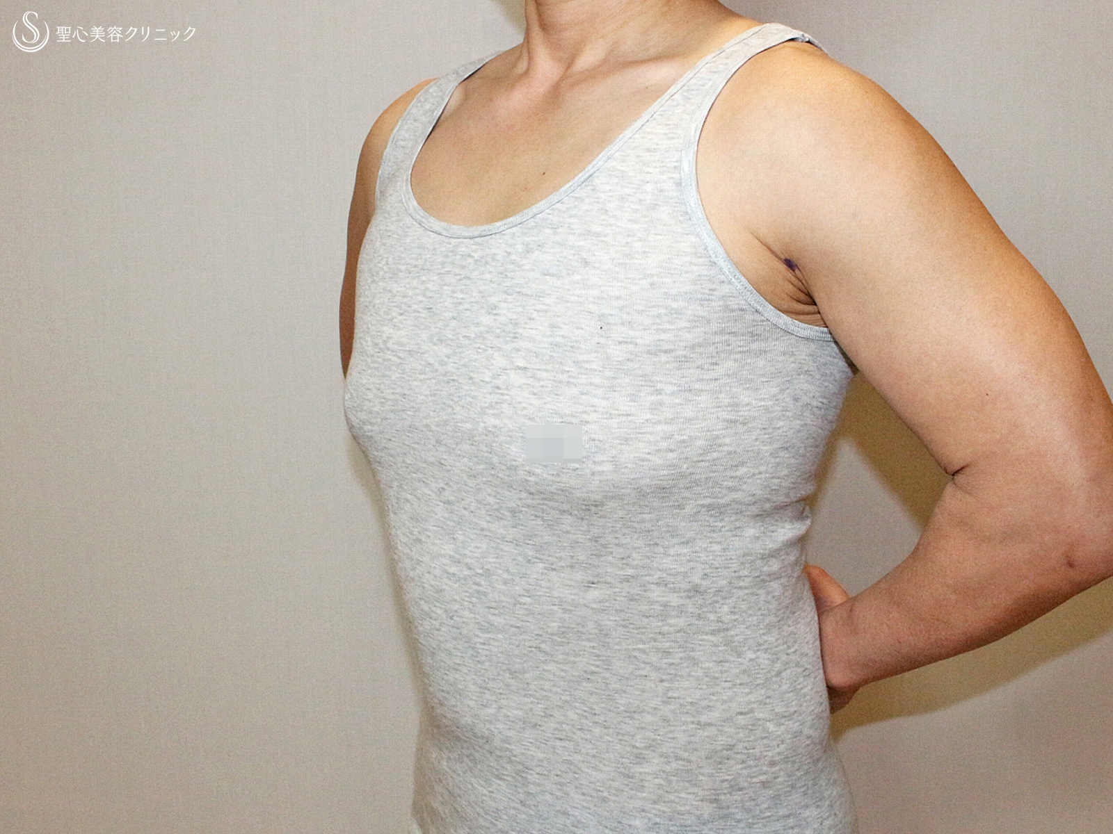 【40代女性・男らしい胸】乳腺切除＆ベイザー脂肪吸引（3ヶ月後） Before 