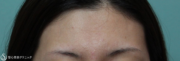 【20代女性・額に女性らしいボリュームを】プレミアムPRP皮膚再生療法（3年後） Before 