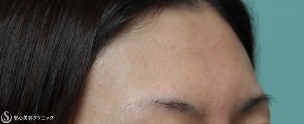 【20代女性・額に女性らしいボリュームを】プレミアムPRP皮膚再生療法（3年後） Before 