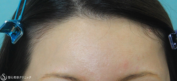 【20代女性・額に女性らしいボリュームを】プレミアムPRP皮膚再生療法（3年後） After 