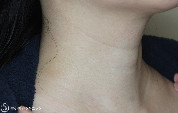 【40代女性・首の横ジワ改善】プレミアムPRP皮膚再生療法（6ヶ月後） Before 