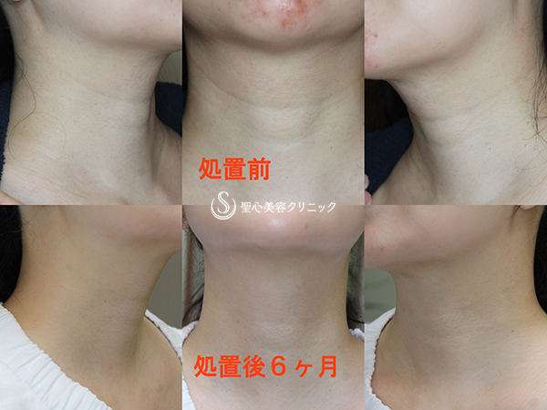 【40代女性・首の横ジワ改善】プレミアムPRP皮膚再生療法（6ヶ月後） After 