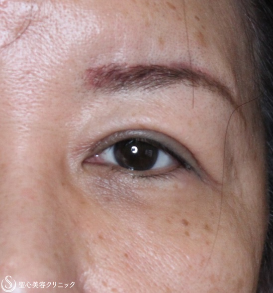 【50代女性・まぶたのたるみを改善】眼瞼下垂（腱膜縫縮法）（2ヶ月後） After 