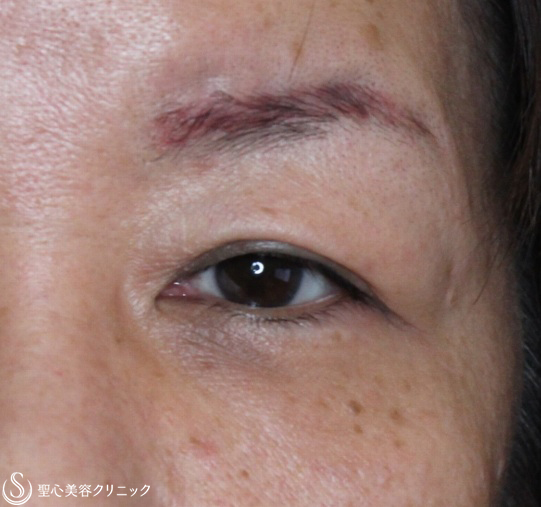 【50代女性・まぶたのたるみを改善】眼瞼下垂（腱膜縫縮法）（2ヶ月後） Before 