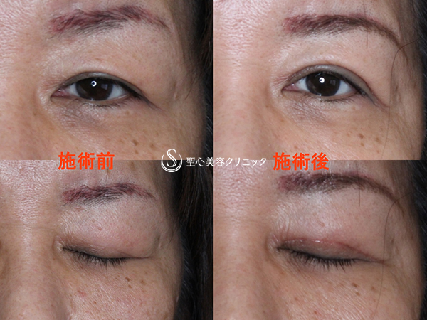 【50代女性・まぶたのたるみを改善】眼瞼下垂（腱膜縫縮法）（2ヶ月後） After 