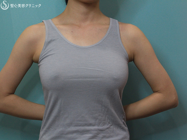 【20代女性・大きめバストをすっきりと】乳房切除術（乳腺切除+脂肪吸引）（3ヶ月後） Before 