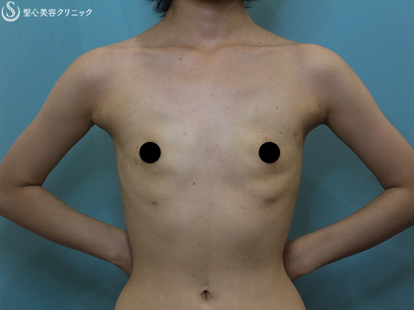 【20代女性・大きめバストをすっきりと】乳房切除術（乳腺切除+脂肪吸引）（3ヶ月後） After 
