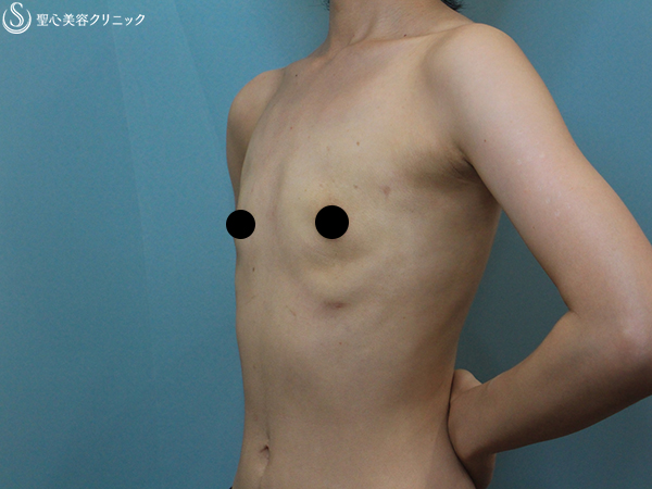 【20代女性・大きめバストをすっきりと】乳房切除術（乳腺切除+脂肪吸引）（3ヶ月後） After 