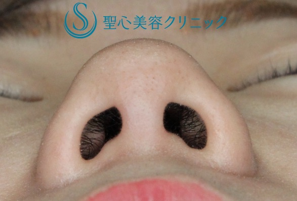 【20代女性・鼻先のコンプレックスを解消する】鼻尖縮小＋α法・鼻翼縮小術（術後9ヶ月） Before 