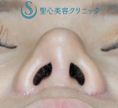 【20代女性・鼻先のコンプレックスを解消する】鼻尖縮小＋α法・鼻翼縮小術（術後9ヶ月） After 