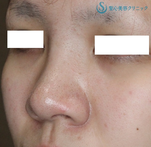 【20代女性・鼻の複合治療】鼻尖縮小術＋α法・鼻翼縮小術（2ヶ月後） Before 