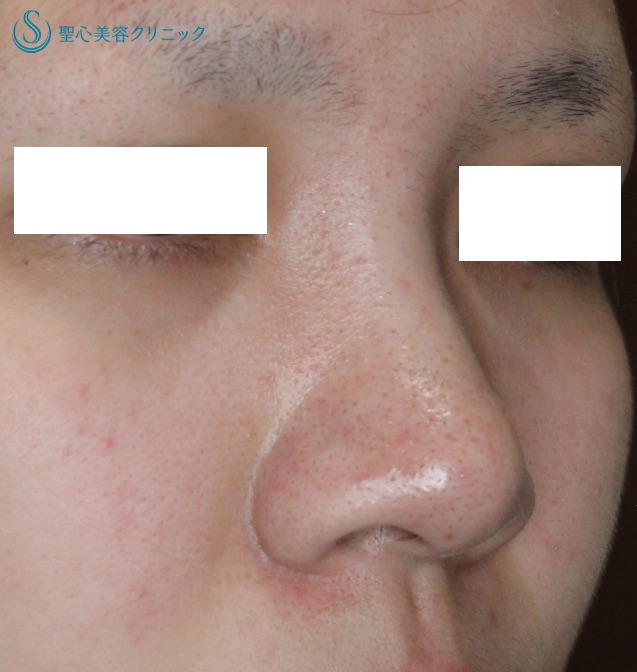 【20代女性・鼻の複合治療】鼻尖縮小術＋α法・鼻翼縮小術（2ヶ月後） Before 