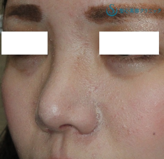 【20代女性・鼻の複合治療】鼻尖縮小術＋α法・鼻翼縮小術（2ヶ月後） After 