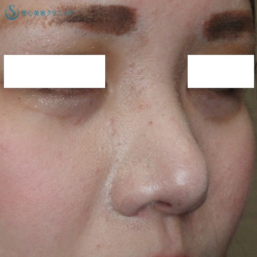 【20代女性・鼻の複合治療】鼻尖縮小術＋α法・鼻翼縮小術（2ヶ月後） After 
