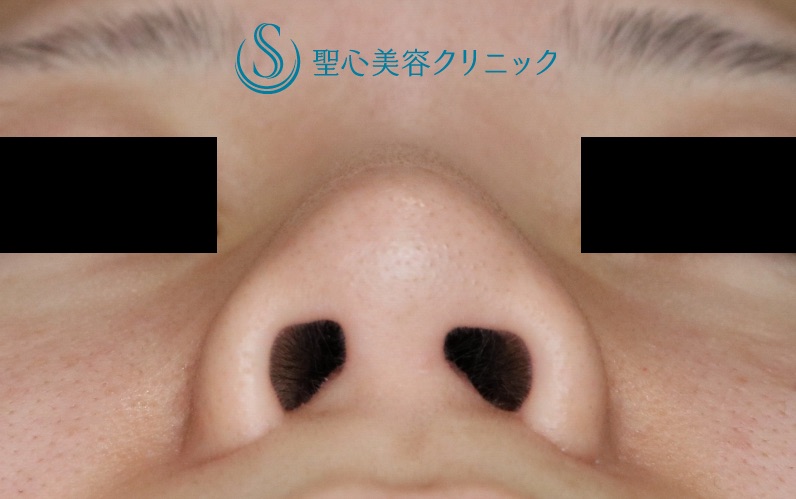 【20代女性・鼻先の改善】鼻尖縮小術＋α法（1ヶ月後） Before 
