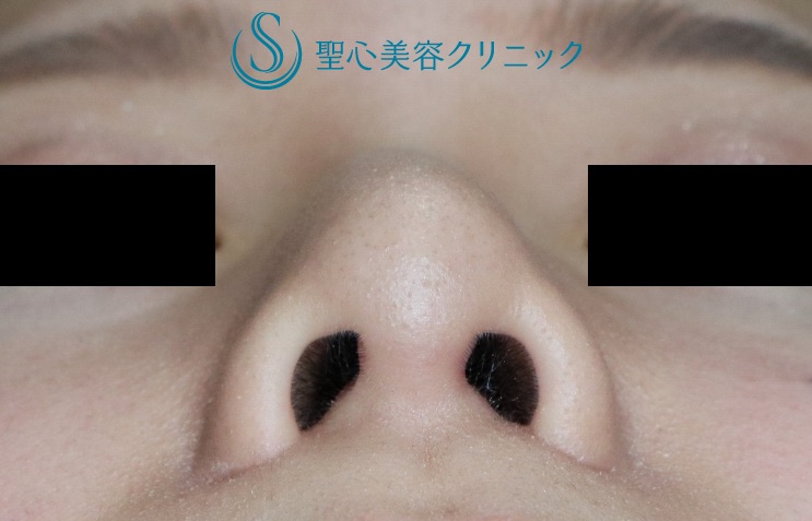 【20代女性・鼻先の改善】鼻尖縮小術＋α法（1ヶ月後） After 
