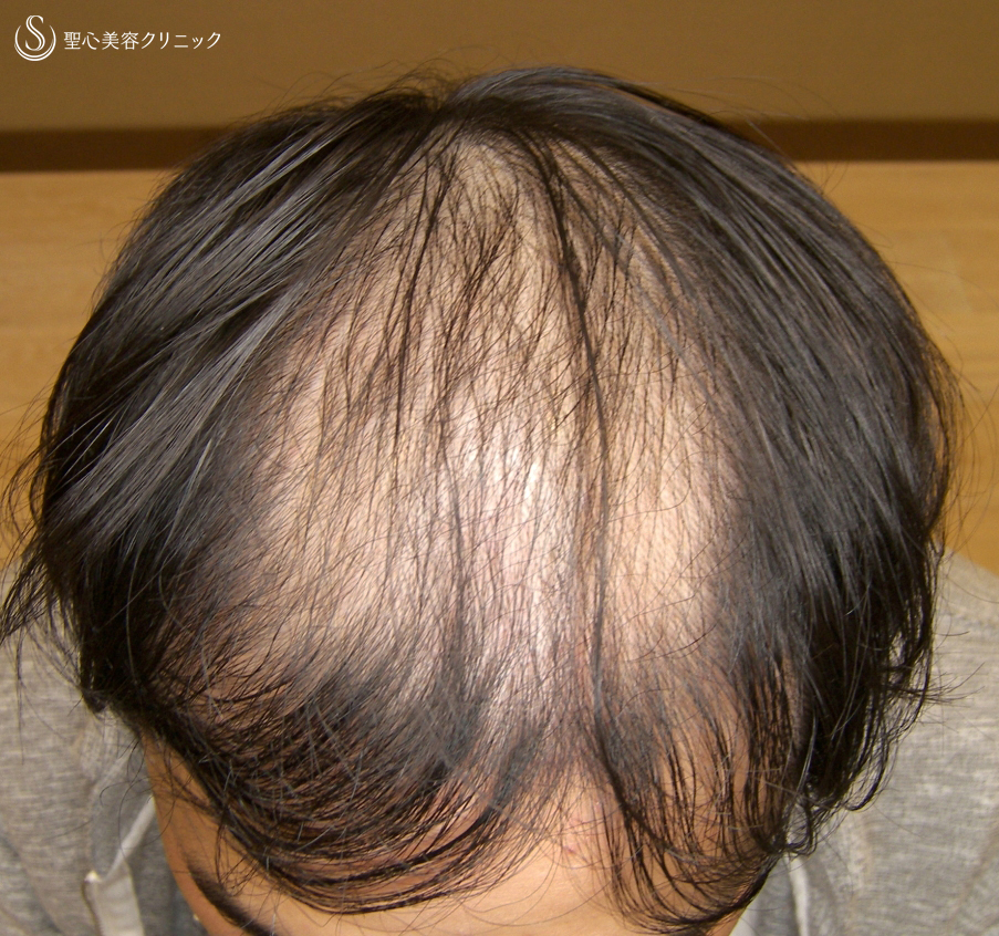 【20代男性・AGA】プレミアムグロースファクター毛髪再生療法（8回後） Before 