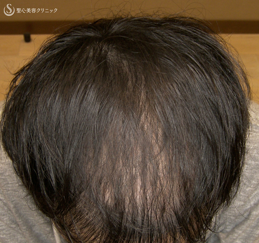 【20代男性・AGA】プレミアムグロースファクター毛髪再生療法（8回後） After 