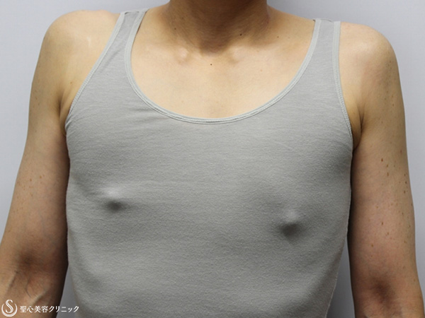 【30代女性・FTM男らしい胸に】乳腺切除+脂肪吸引（2ヶ月後） After 