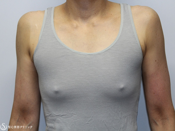 【30代女性・FTM男らしい胸に】乳腺切除+脂肪吸引（2ヶ月後） Before 
