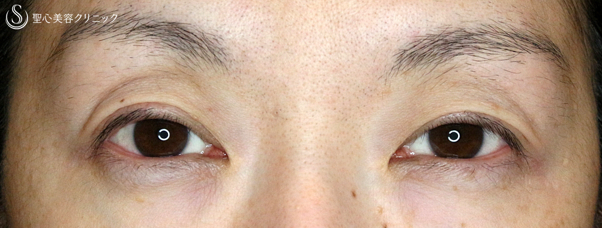 【40代女性・目が重く左右差あり】切らない眼瞼下垂+α法（2年後） Before 