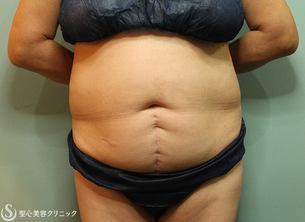【60代女性・切らずに腹部痩身】リポセル（3ヶ月後） Before 