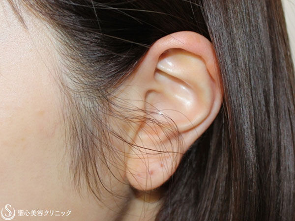 【20代女性・ふっくらとした耳たぶを小さく】耳たぶの修正（1ヶ月後） Before 