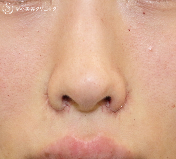 【20代女性・鼻の存在感をなくす】小鼻縮小術+α法（8ヶ月後）札幌院 Before 