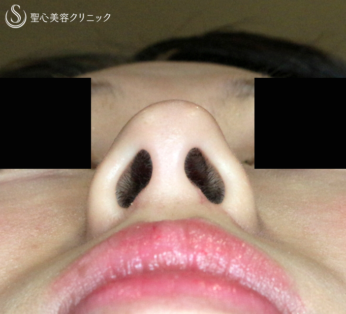 【20代女性・鼻の存在感をなくす】小鼻縮小術+α法（8ヶ月後）札幌院 After 