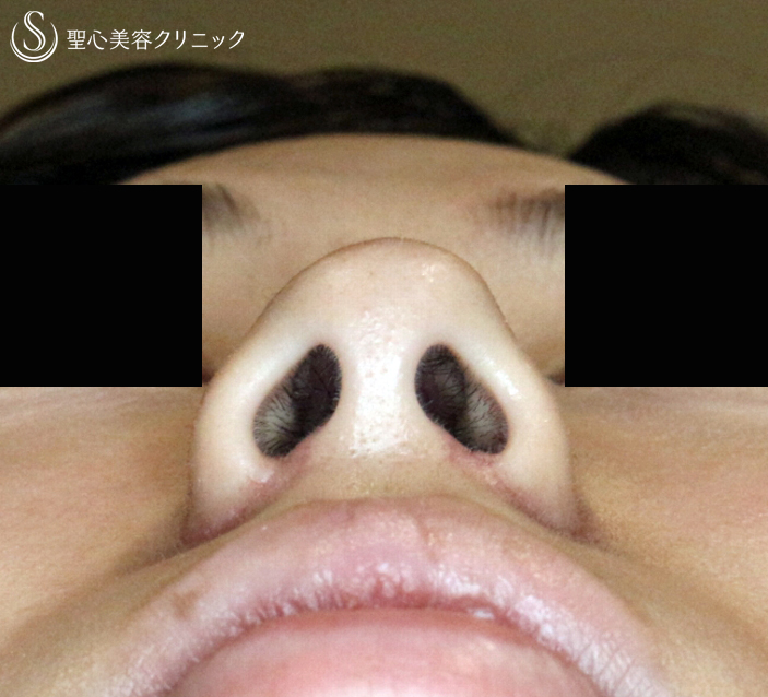 【20代女性・鼻の存在感をなくす】小鼻縮小術+α法（8ヶ月後）札幌院 After 