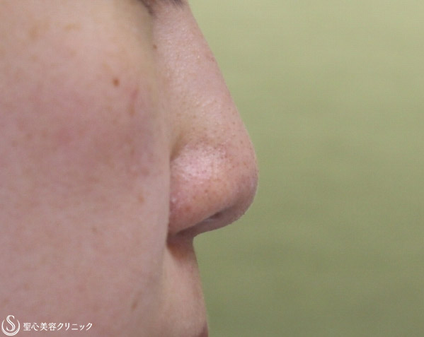 【20代女性・鼻先をシャープに】鼻先縮小＋耳介軟骨移植 Before 