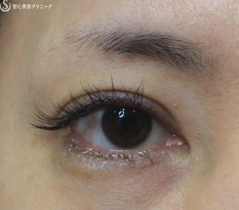 【40代女性・腫れが少ない二重埋没法】マイクロメソッド＋α法（術直後） After 