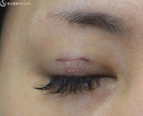 【40代女性・腫れが少ない二重埋没法】マイクロメソッド＋α法（術直後） After 