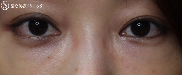 【30代女性・目元の若々しさ持続】プレミアムPRP皮膚再生療法（4年後） After 