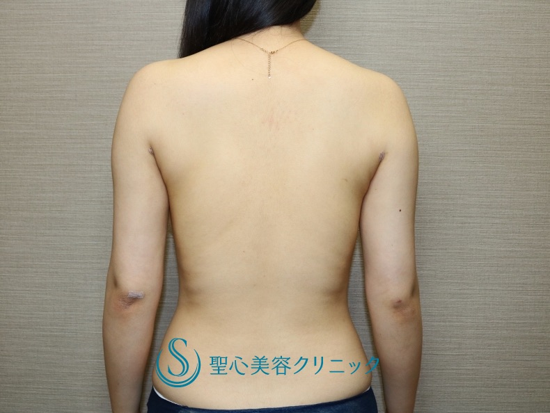 代女性 二の腕と肩周りをスッキリ ベイザーリポ脂肪吸引 1ヶ月後 症例写真 美容整形 美容外科なら聖心美容クリニック