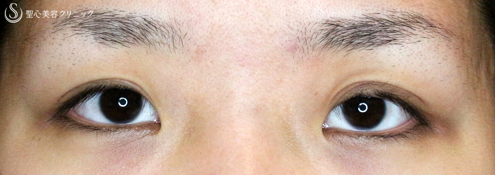 【20代女性・華やかな目元へ】目頭切開＆二重全切開+α法（5年後） Before 