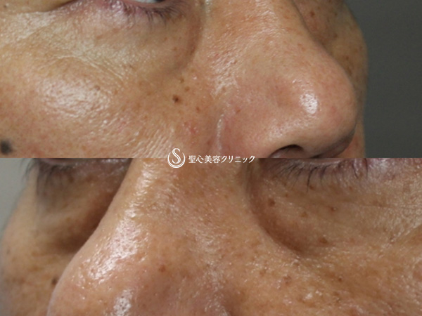 【40代男性・目の下の若返り】プレミアムPRP皮膚再生療法（1ヶ月後） Before 