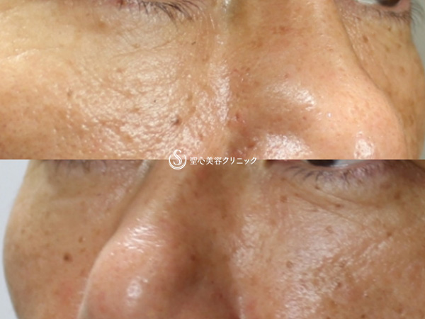【40代男性・目の下の若返り】プレミアムPRP皮膚再生療法（1ヶ月後） After 